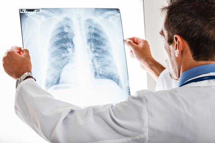 Une toux sans autres symptômes pourrait être un cancer du poumon.