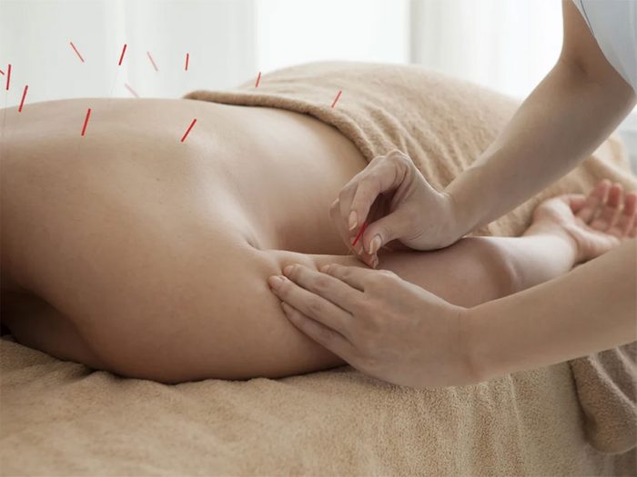 L'acupuncture peut soulager votre mal de dos.