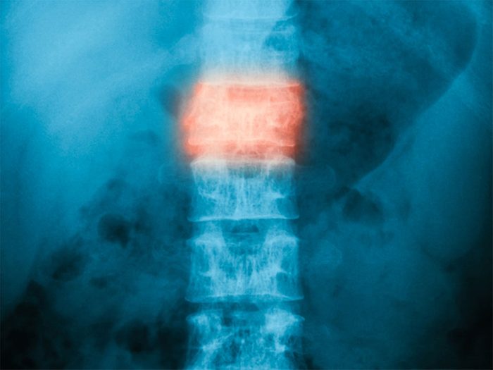 Une fracture de la colonne peut expliquer votre mal de dos.