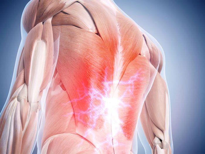 Le froissement des muscles, tendons et ligaments provoque votre mal de dos.