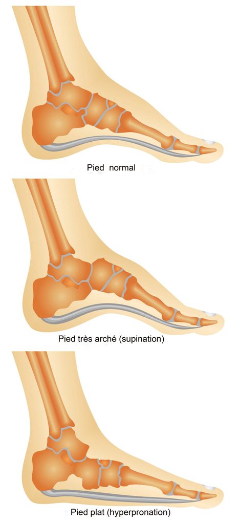 Quelle est la forme de votre pied?