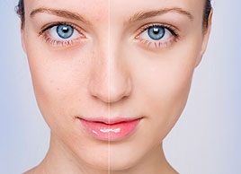 Trucs et remèdes naturels contre l'acné