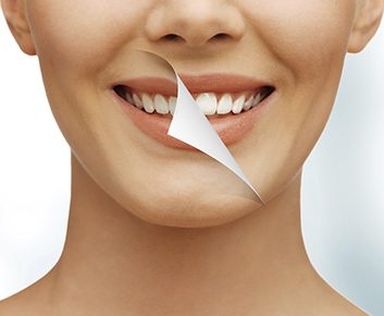 Banc d'essai : Blanchiment de dents chez Spa dentaire Laurier