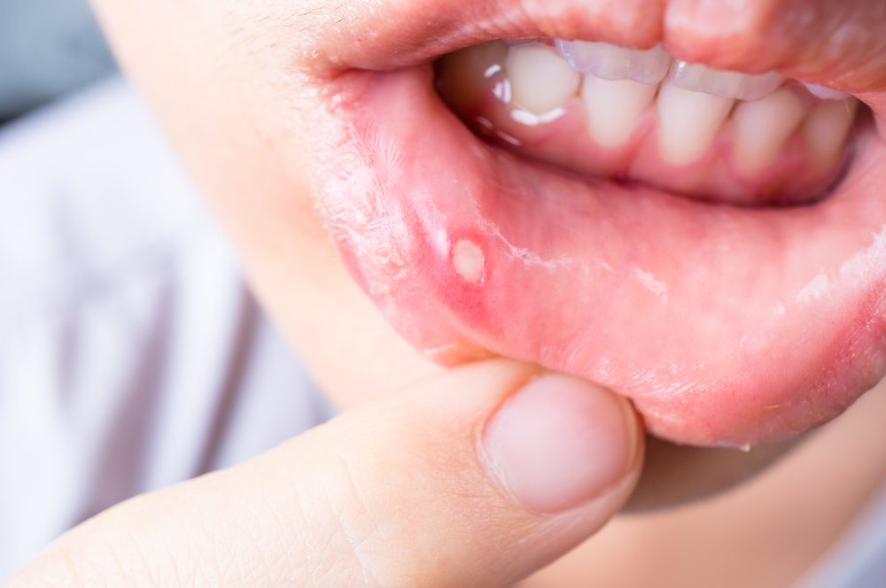 Présence d'aphtes et ulcères dans la bouche: causes, remèdes et possibilités de cancer de la bouche.