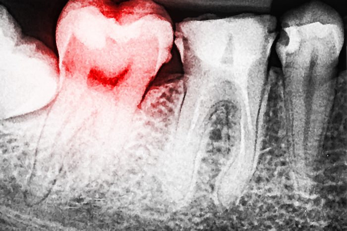Attention à la présence de points blancs sur les dents, pouvant indiquer la carie