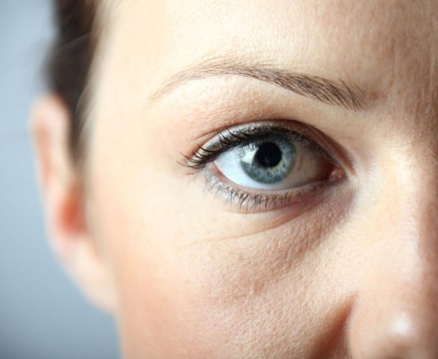 Des cernes et des yeux bouffis peuvent être le signe d'allergies chroniques. 