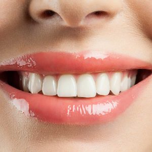 Dents tachées: le secret d’un sourire parfait