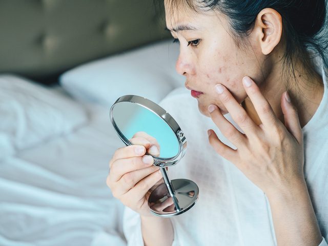 Une personne avec de l'acn se regarde dans un miroir.