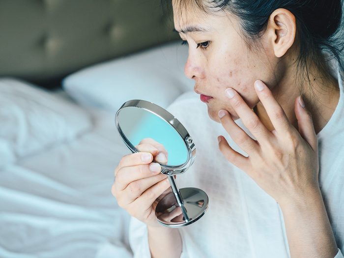 Une personne avec de l'acné se regarde dans un miroir.