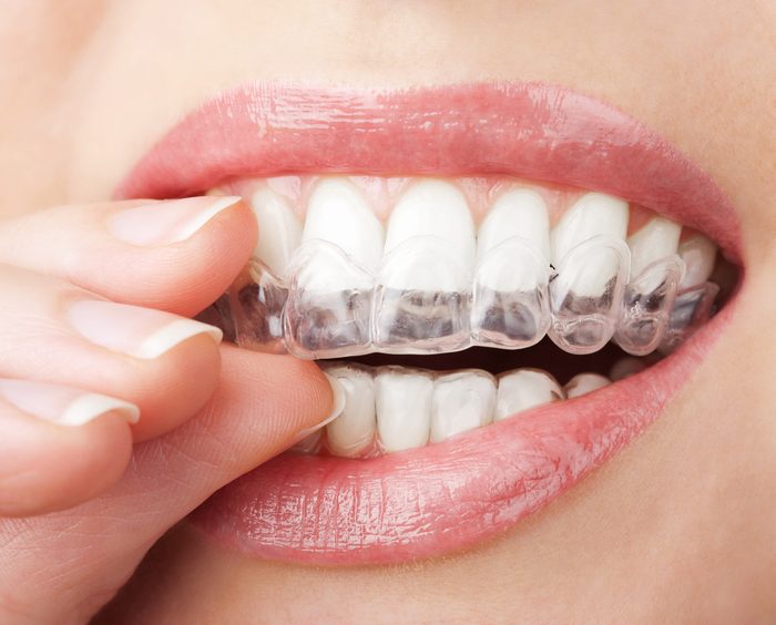 Le blanchiment de dents peut également causer une douleur dentaire
