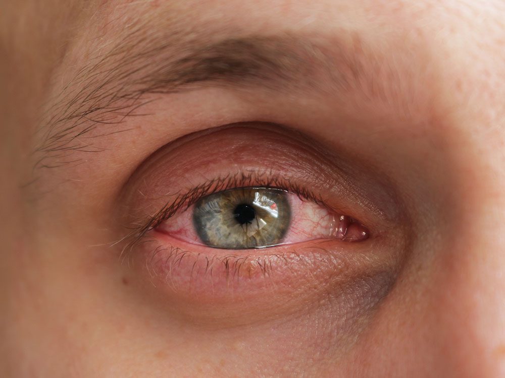 La conjonctivite fait partie des maladies des yeux que vous devriez connaître.