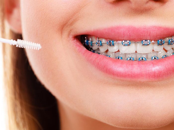 Un appareil dentaire mal nettoyé peut causer une mauvaise hygiène dentaire.