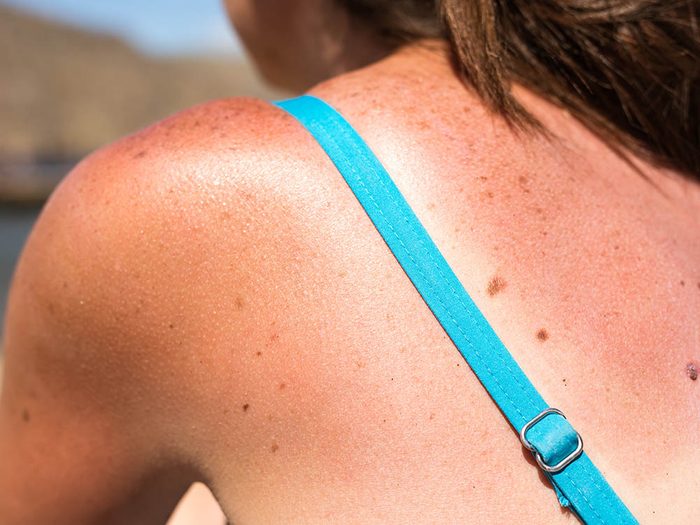 Le cancer de la peau peut se déclarer suite à des coups de soleil à répétition.