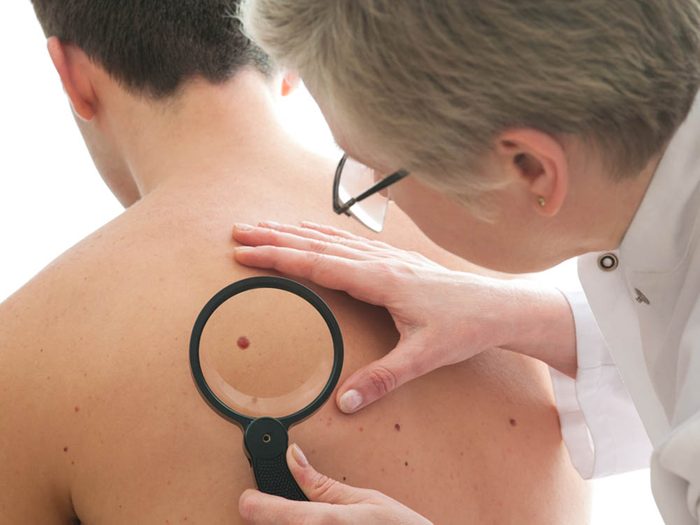 Détectez le cancer de la peau le plus tôt possible.