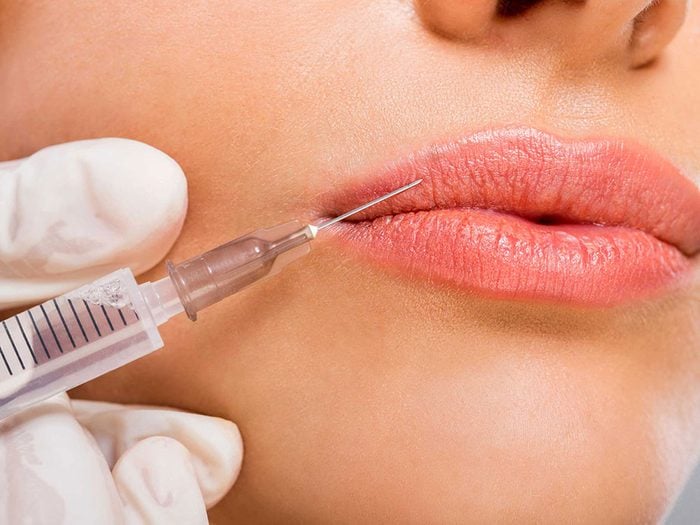 Une injection de neuromodulateur – Botox, Dysport ou Xeomin – arrive souvent à dompter les rides autour des lèvres.