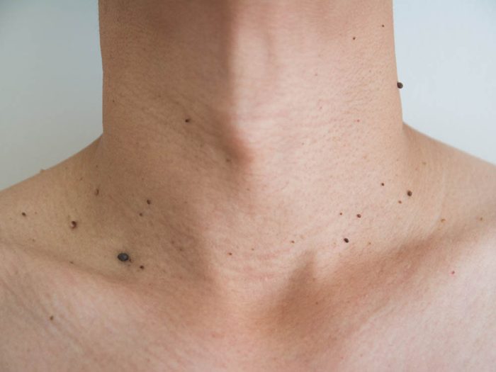 Santé des hommes: la transformation de grains de beauté peut être le signe d’un cancer de la peau.