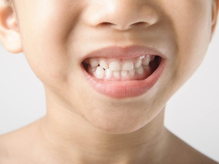 Conseil de dentistes: les dents de lait aussi peuvent avoir besoin de plombage.