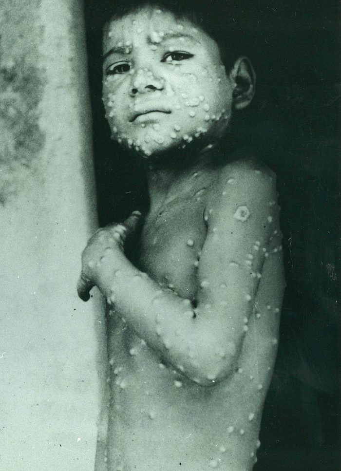 Chair de poule : photo d'un enfant atteint de variole.
