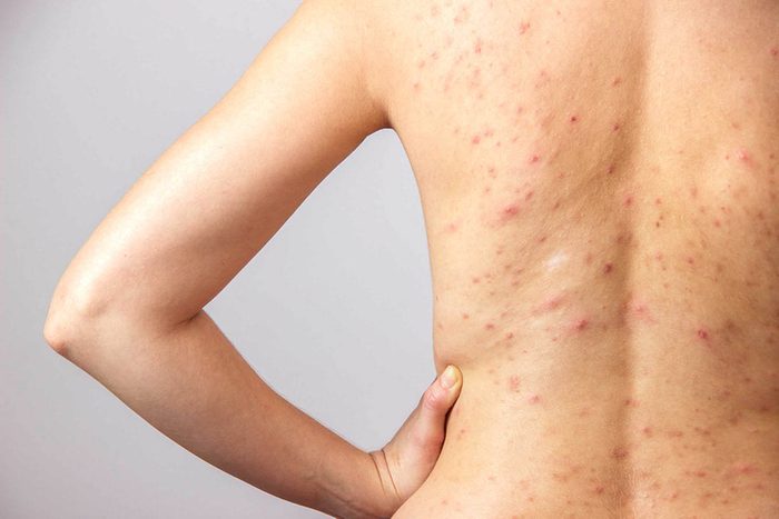 L'acné sur le dos, les bras et les cuisses est une question de génétique et de fluctuations hormonales.
