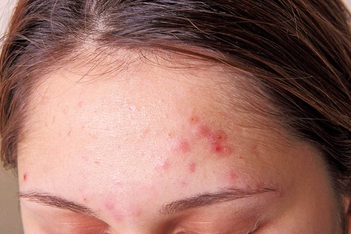 L'acné sur le front révèle des problèmes de digestion et de stress.