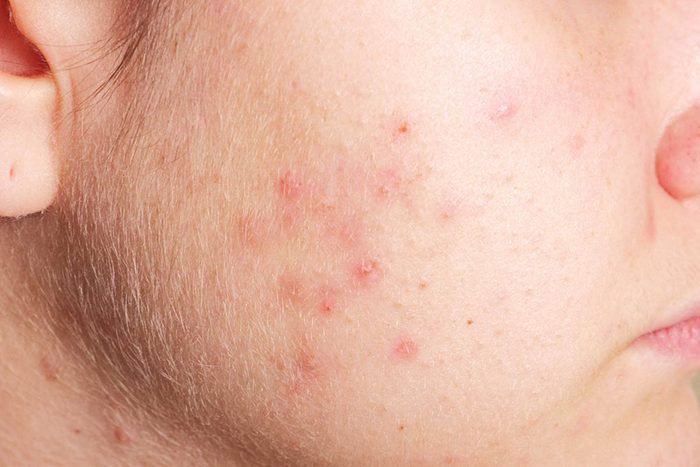 L'acné sur les joues est liée au système respiratoire.