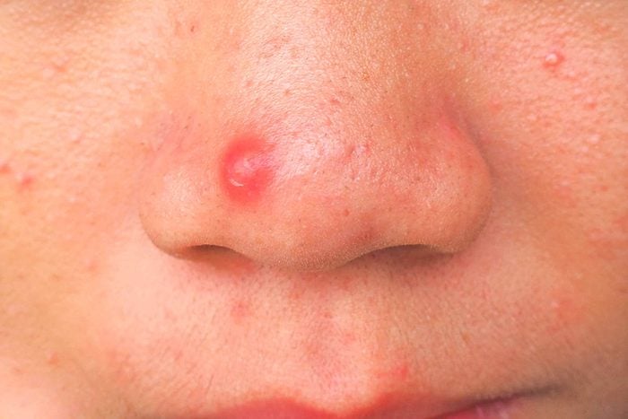 L'acné sur la zone T est causée pas un déséquilibre gastro-intestinal ou des allergies alimentaires.