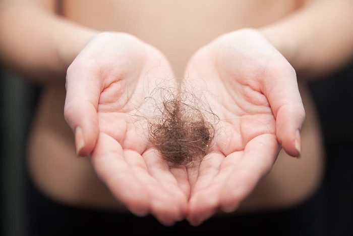 La perte de cheveux peut être causée par la pelade.
