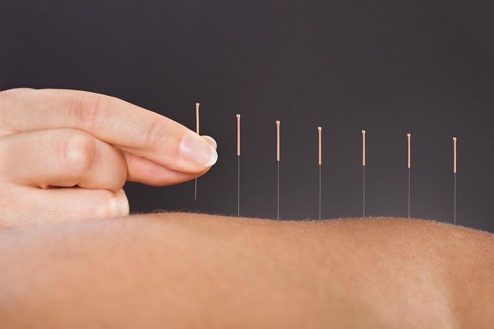 Ménopause : atténuez les symptômes grâce à l'acupuncture.