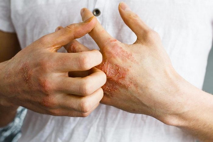 Symptômes de maladies : le psoriasis peut être un premier signe d'arthrite.