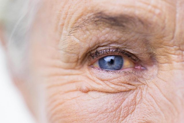 Symptmes de maladies : la jaunisse du blanc de l'oeil peut tre un signe d'hpatite.