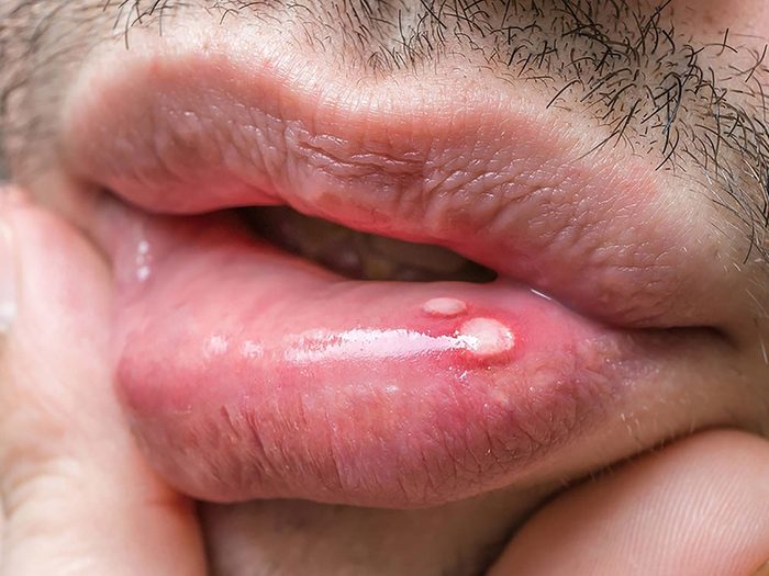 Une douleur dans la bouche peut être un sogne de cancer chez l'homme.