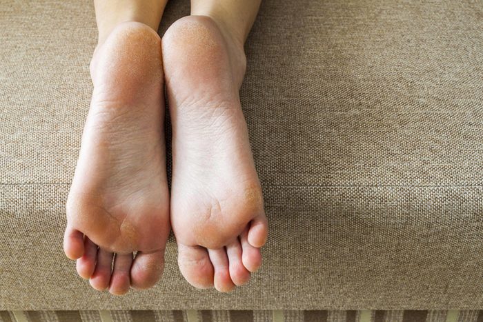Symptôme d'anémie : vos mains et vos pieds sont froids