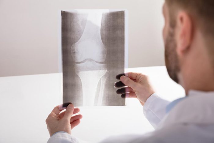 Arthrite : les rayons X restent le meilleur outil de diagnostic.