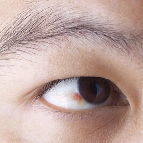 Signe inquiétant du corps : des taches récurrentes de sang dans l’œil.
