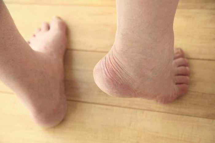 Symptôme d'une hernie discale : douleurs dans les pieds.