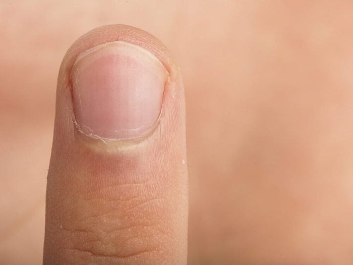 La couleur des ongles peut révéler des maladies rénales