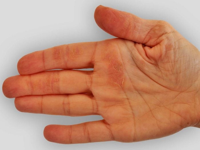 10 maladies que vos mains peuvent prédire | Sélection.ca
