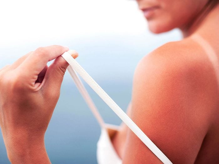 Cancer de la peau: il suffit de quelques minutes pour attraper un coup de soleil.