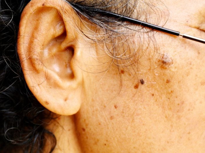 Surveillez les autres irrégularités de la peau pour détecter le cancer de la peau.