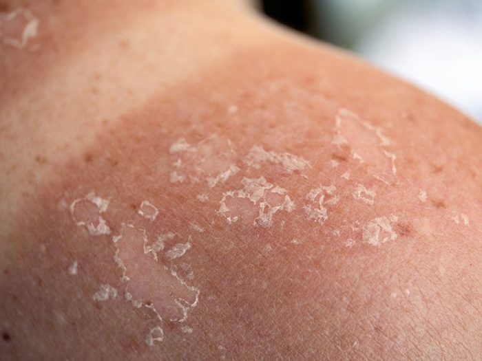 Cancer de la peau: tous les coups de soleil ne se valent pas!
