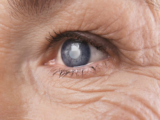 Cataracte: 7 symptmes silencieux  reconnatre.