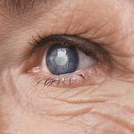7 symptômes silencieux de la cataracte à reconnaître