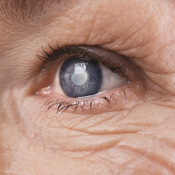 Cataracte: 7 symptômes silencieux à reconnaître.