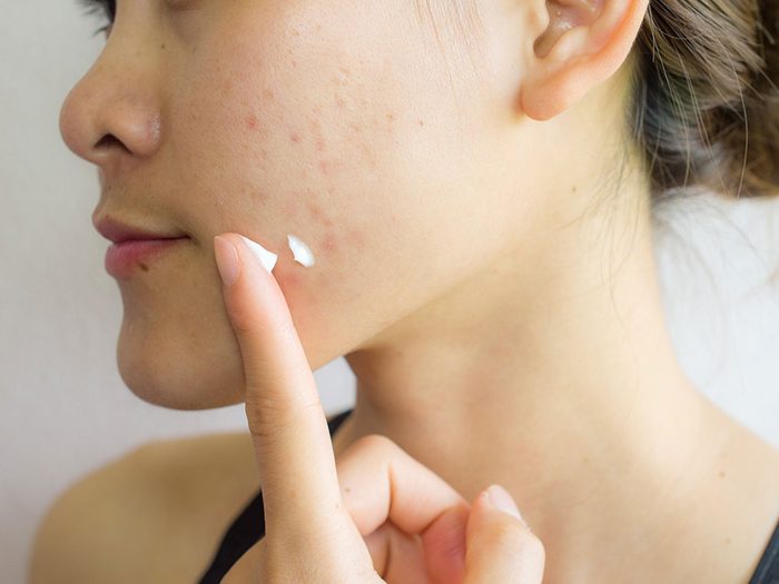 La prise de vitamines est conseillée pour se débarrasser des cicatrices d'acné.