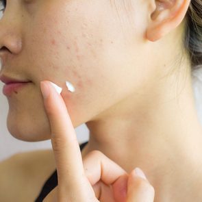 La prise de vitamines est conseillée pour se débarrasser des cicatrices d'acné.