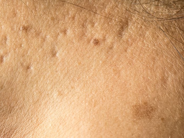 Il est possible de combler les cicatrices d'acné.