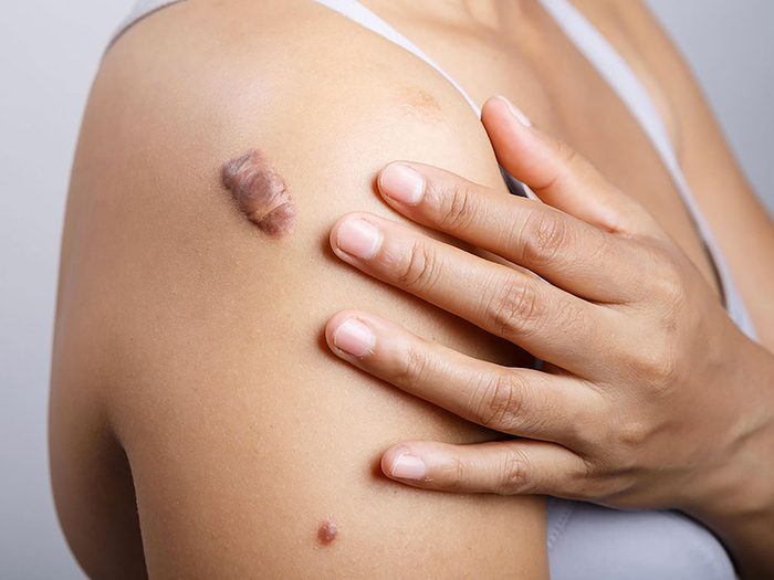 Cicatrices d'acné: un nouvel espoir pour les chéloïdes. 