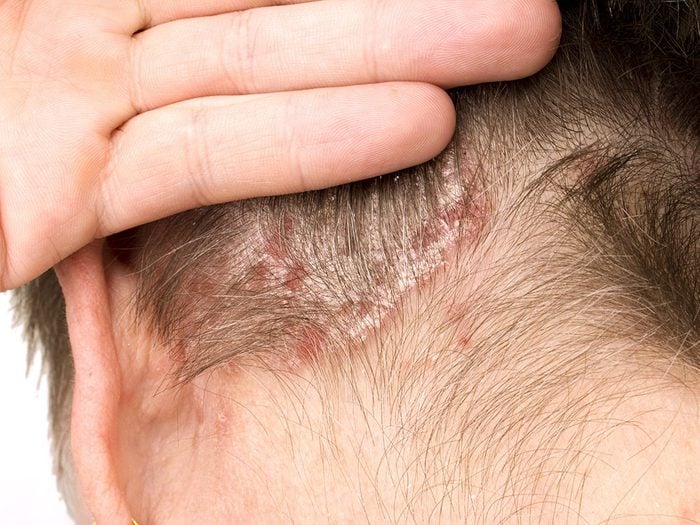 Irritation de la peau: les plaques rouges et écailleuses du psoriasis peuvent être prurigineuses ou douloureuses.