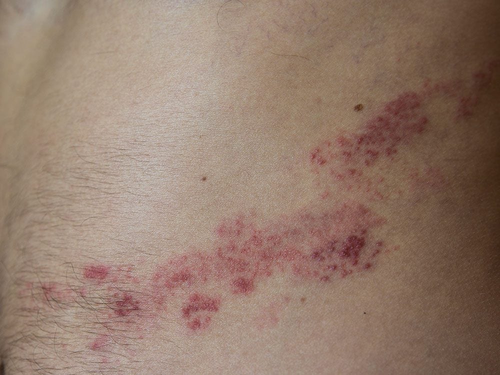Irritation de la peau: 6 dermatoses courantes à connaître