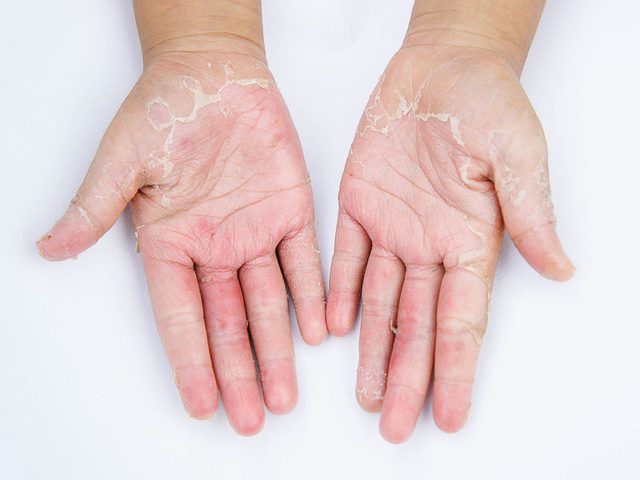 La dermatite de contact ets une irritation de la peau.
